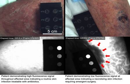 Images of skin of person with suspected necrotizing soft-tissue infection and a corresponding MRI image of their infection. One person has an NSTI while the other doesn't.